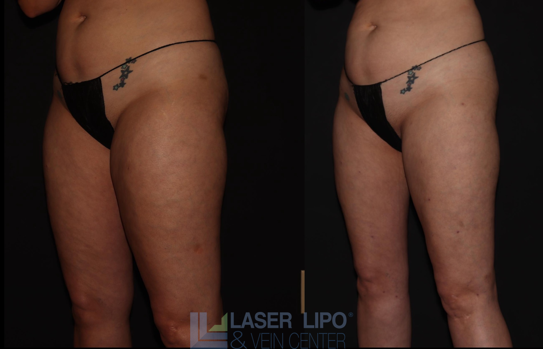 Before and After Image: Stage 1 – Thighs - left-front-oblique