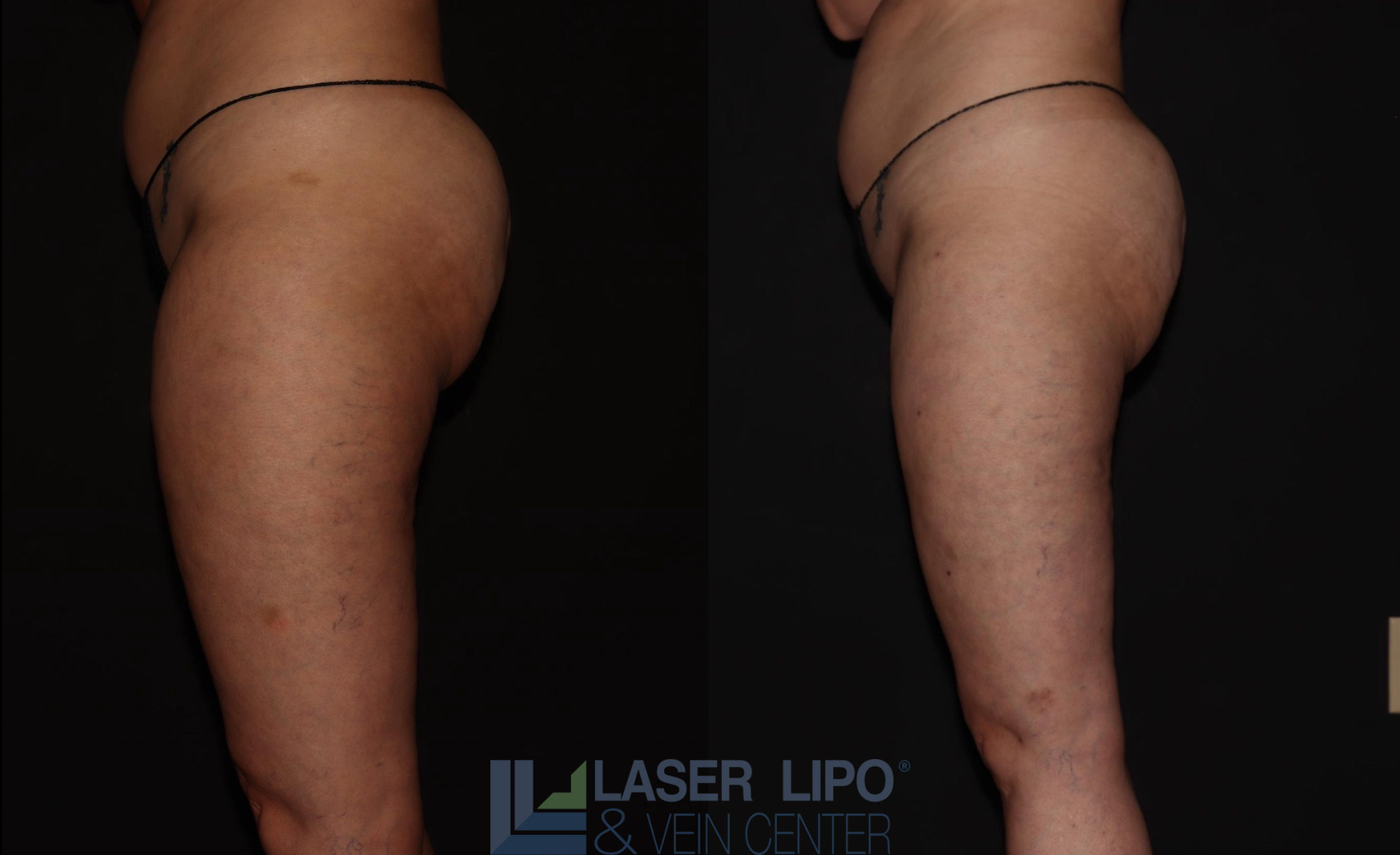 Before and After Image: Stage 1 – Thighs - left-side
