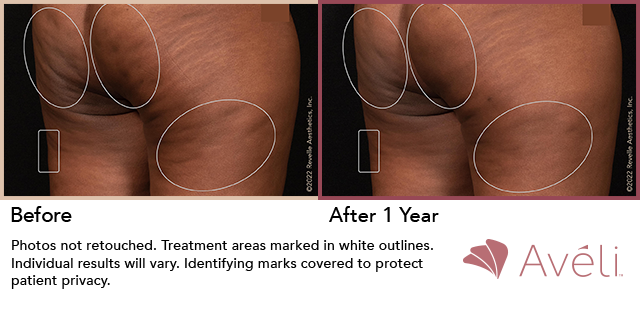 Aveli Cellulite Treatment St Louis Dr Wright 