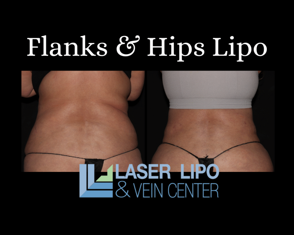 Flanks & Hips Lipo St. Louis Laser Lipo and Vein