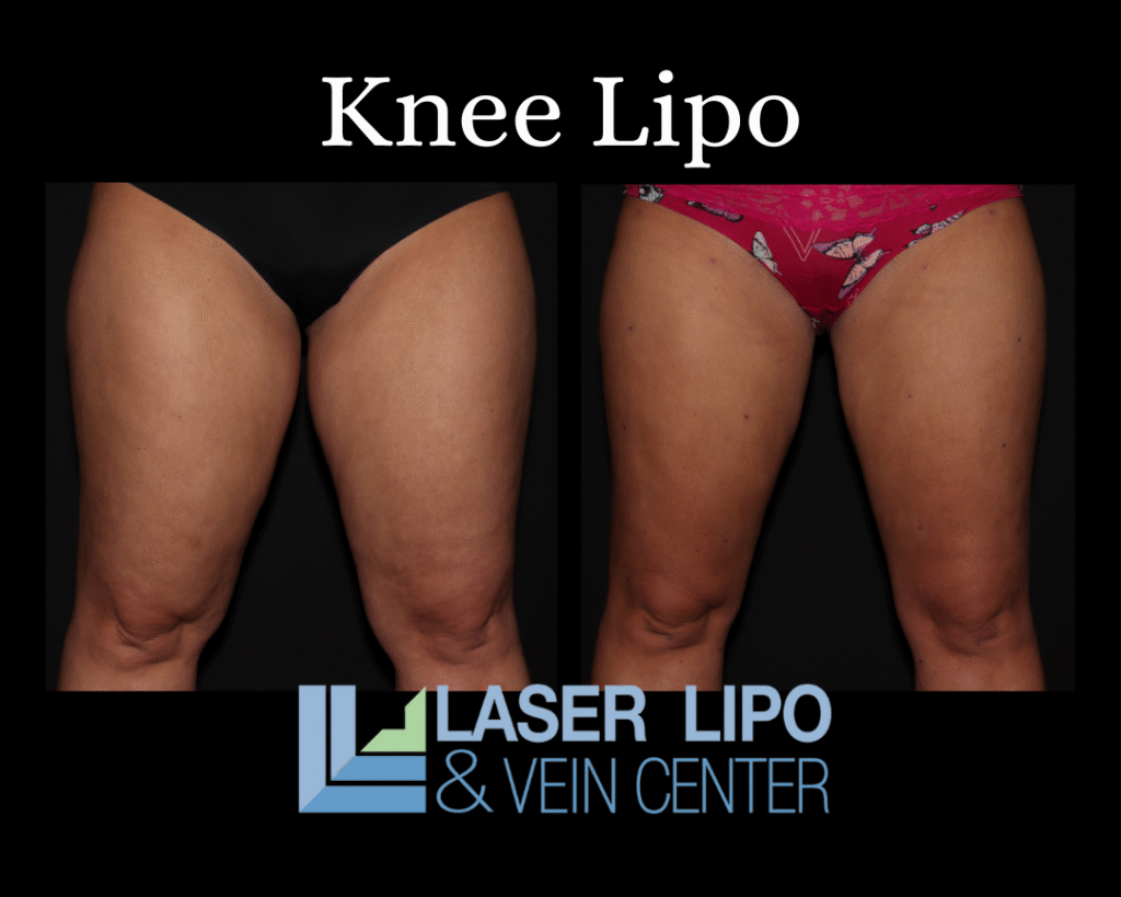 Knee Lipo St. Louis Laser Lipo and Vein