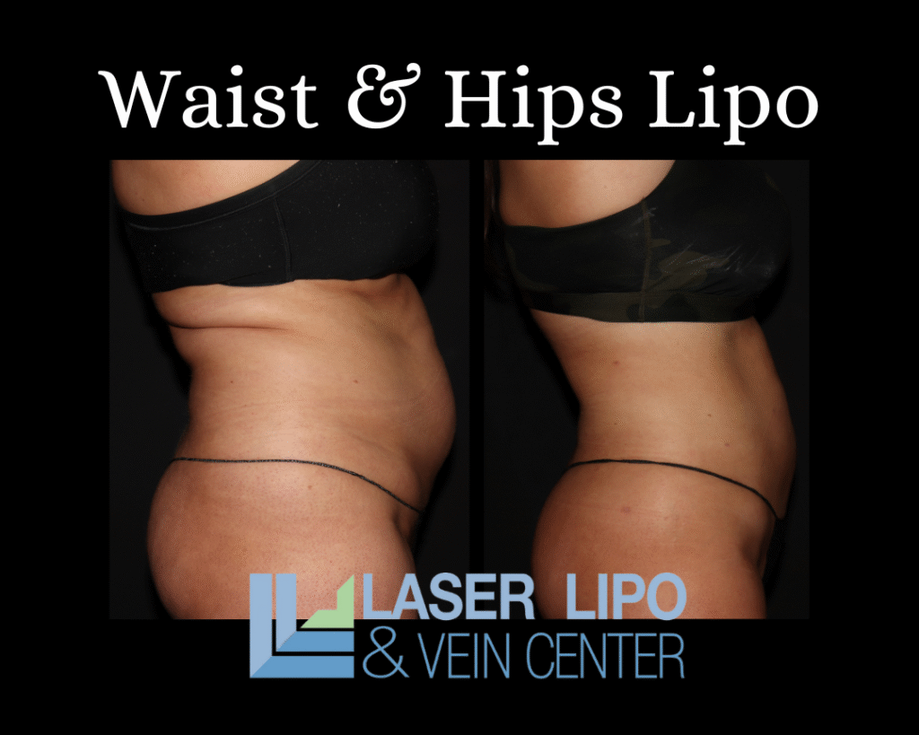 Waist & Hips Lipo St. Louis Laser Lipo and Vein2