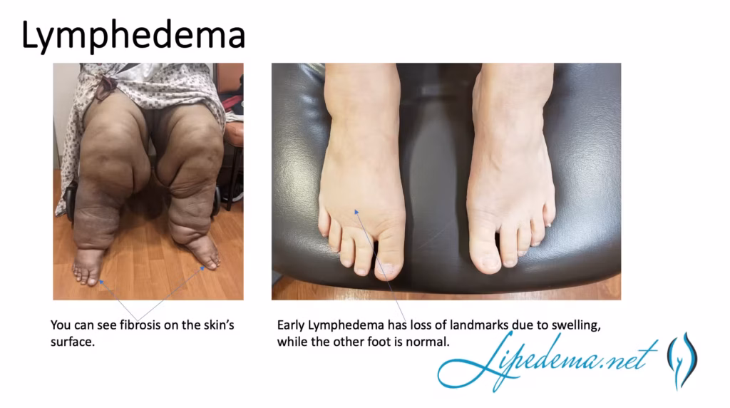 New Slide Lymphedema Dr Wright FDRS Lipedema vs Lymphedema.png New Slide Lymphedema Dr Wright FDRS Lipedema vs Lymphedema.png